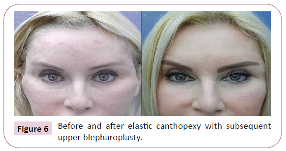 aesthetic-reconstructive-surgery-blepharoplasty