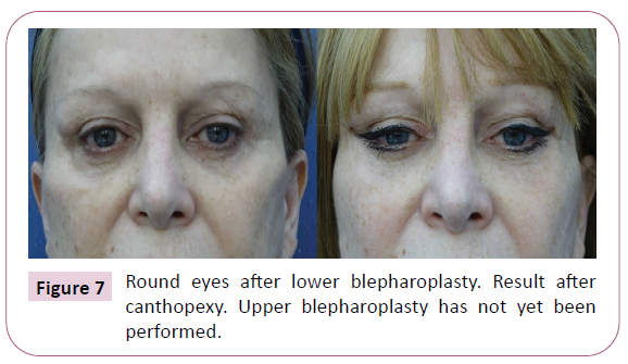 aesthetic-reconstructive-surgery-canthopexy