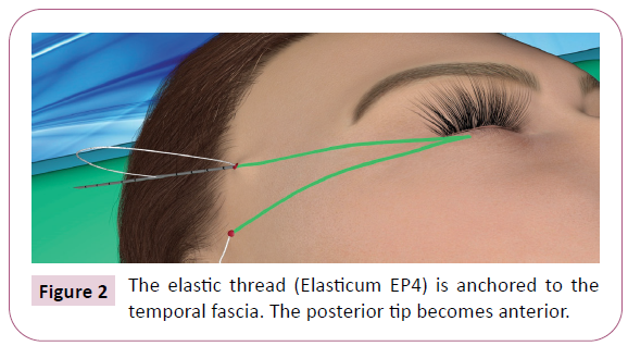 aesthetic-reconstructive-surgery-elastic-thread