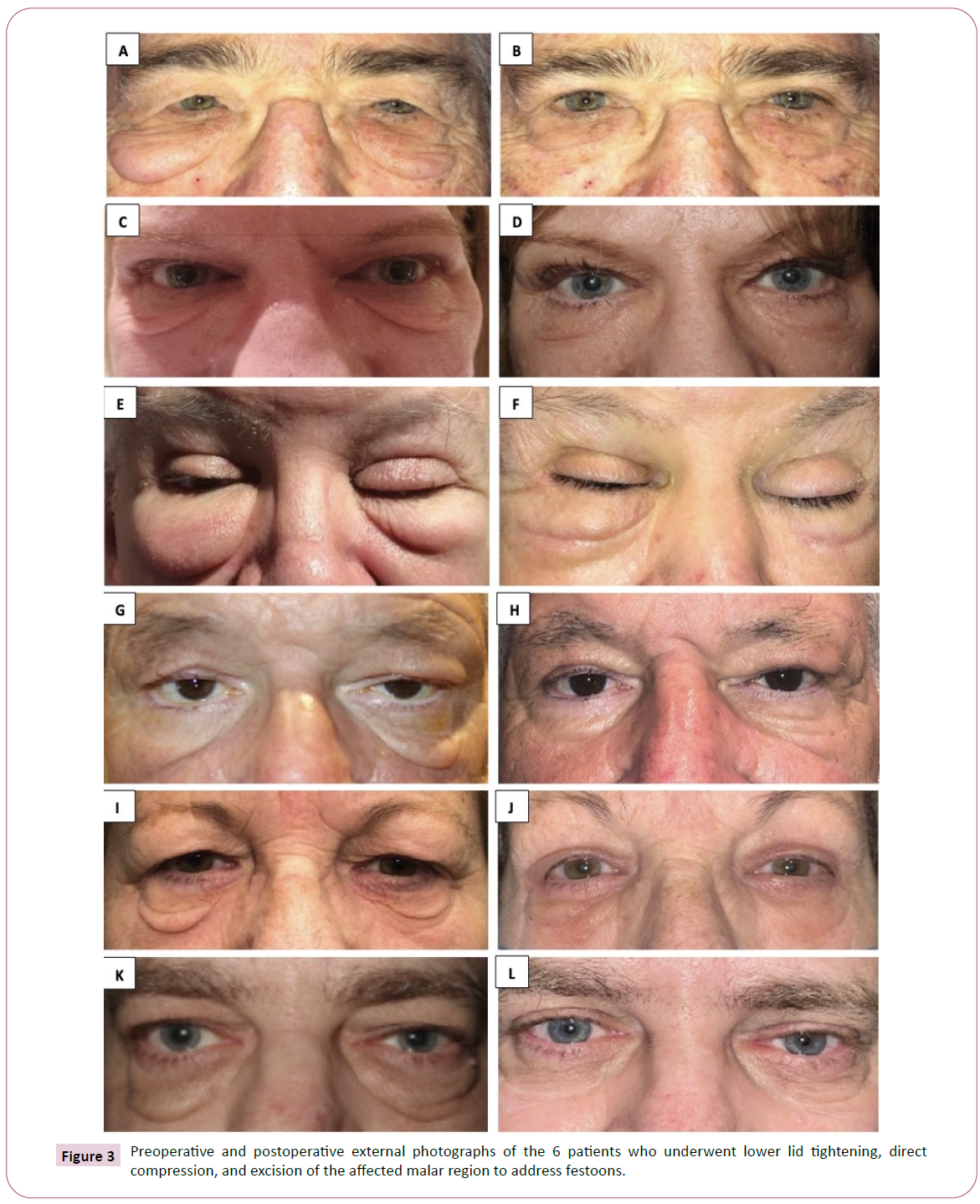 Festoons Treatment (Under Eye Bag Surgery) | Dr. Allan Wulc