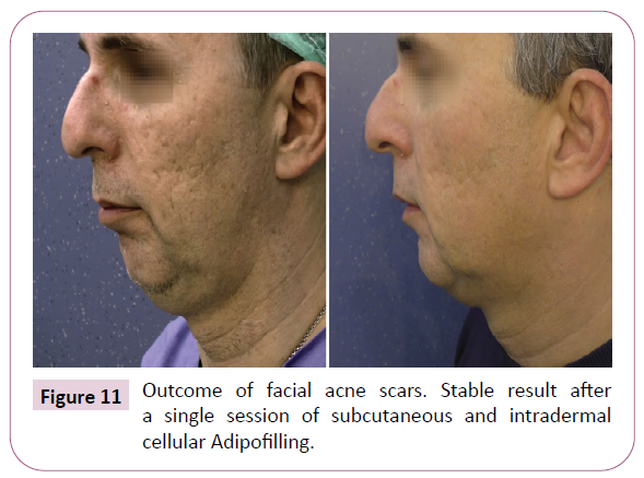 aesthetic-reconstructive-surgery-intradermal-cellular