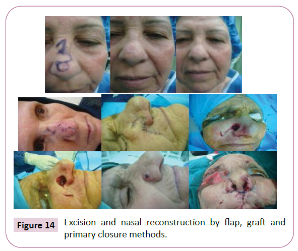 aesthetic-reconstructive-surgery-nasal-reconstruction
