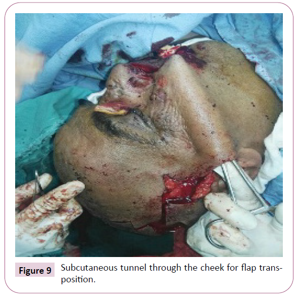 aesthetic-reconstructive-surgery-subcutaneous-tunnel