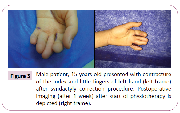 aesthetic-reconstructive-surgery-syndactyly-correction