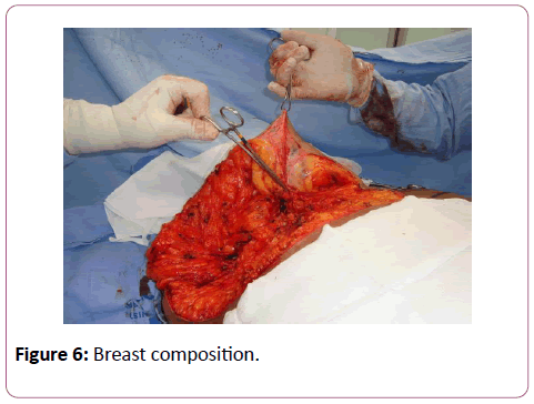 aesthetic-reconstructive-surgery-Breast-composition