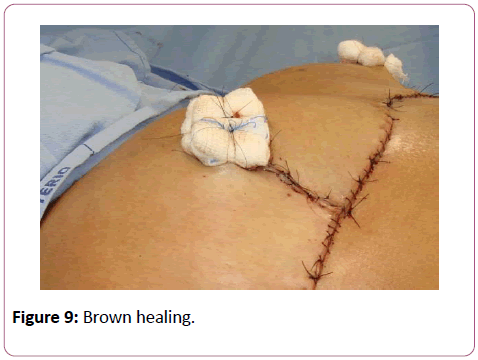 aesthetic-reconstructive-surgery-Brown-healing