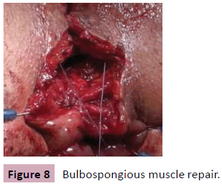 aesthetic-reconstructive-surgery-Bulbospongious-muscle-repair