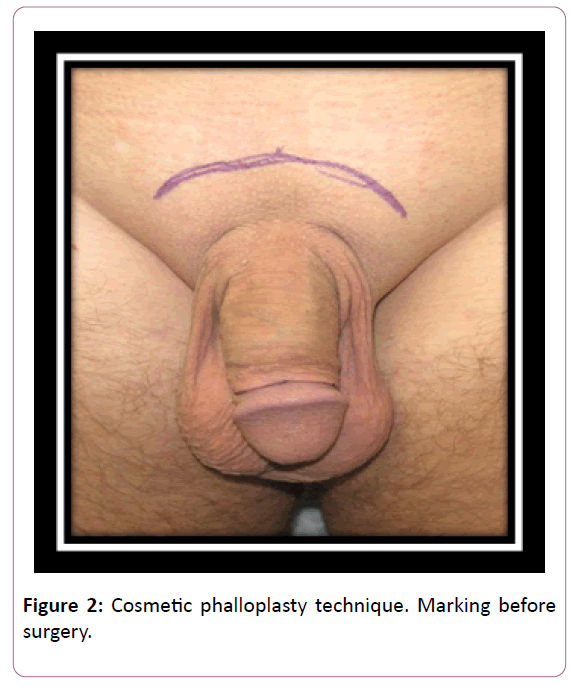 aesthetic-reconstructive-surgery-Cosmetic-phalloplasty