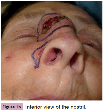aesthetic-reconstructive-surgery-Inferior-view-nostril