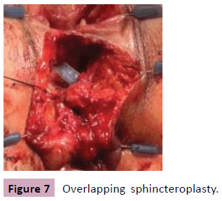 aesthetic-reconstructive-surgery-Overlapping-sphincteroplasty