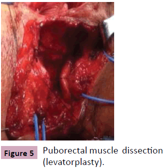aesthetic-reconstructive-surgery-Puborectal-muscle-dissection