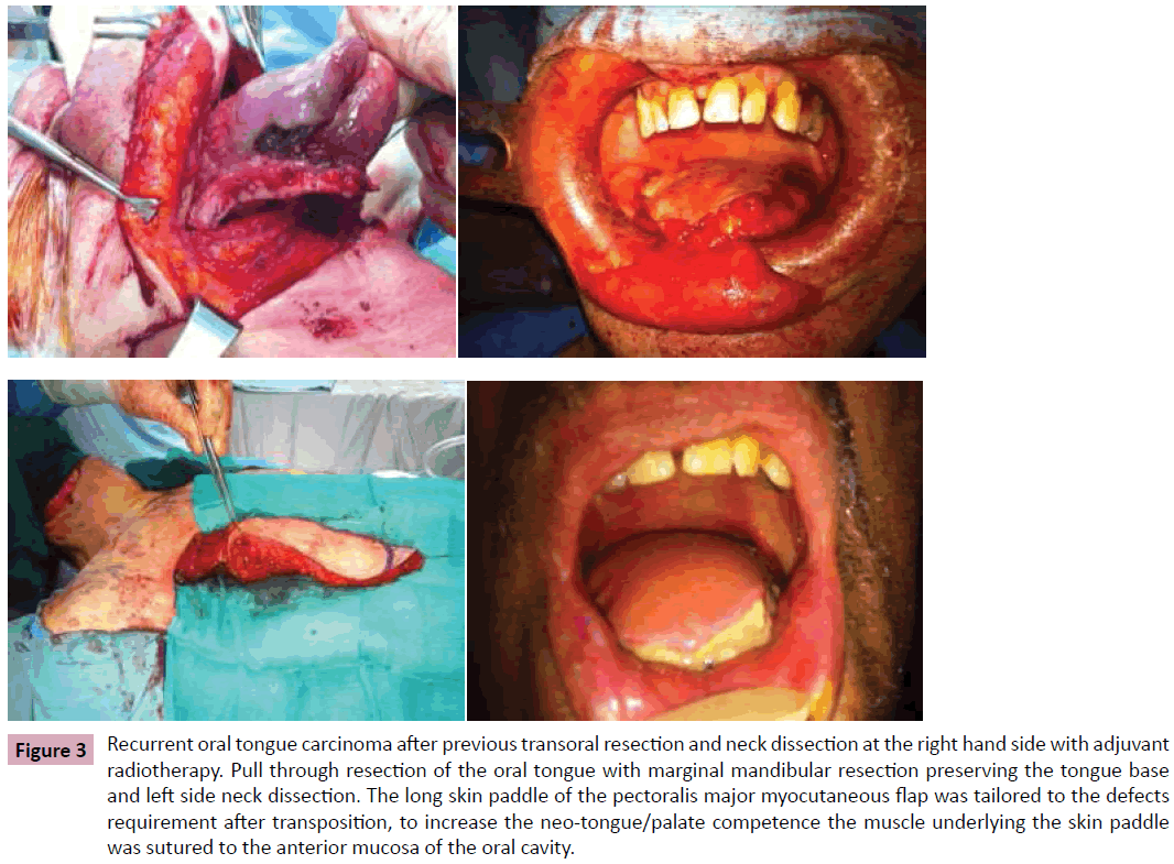 aesthetic-reconstructive-surgery-Recurrent-oral-tongue