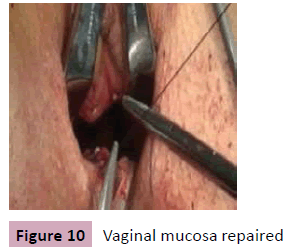 aesthetic-reconstructive-surgery-Vaginal-mucosa-repaired