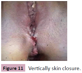 aesthetic-reconstructive-surgery-Vertically-skin-closure