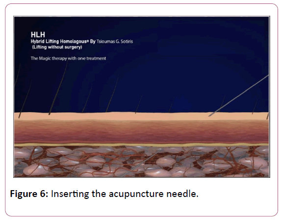 aesthetic-reconstructive-surgery-acupuncture-needle