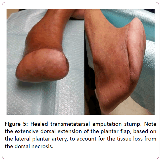 aesthetic-reconstructive-surgery-amputation-stump