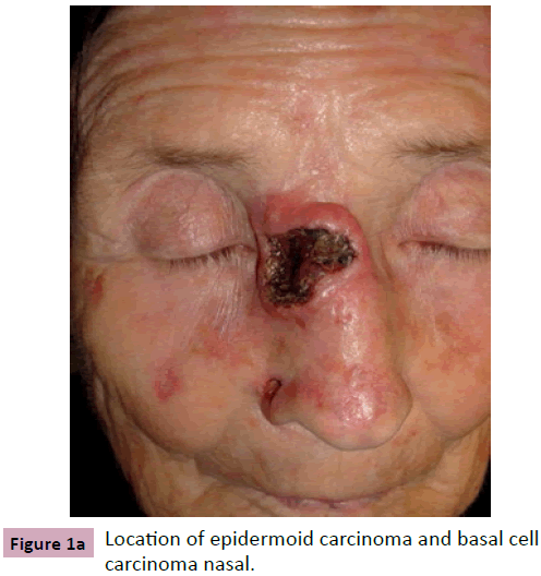 aesthetic-reconstructive-surgery-epidermoid-carcinoma