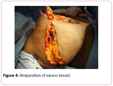 aesthetic-reconstructive-surgery-excess-breast