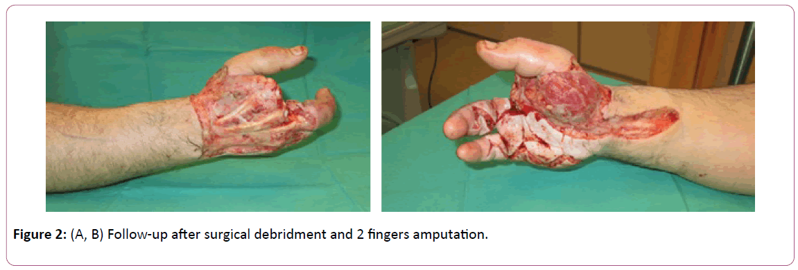 aesthetic-reconstructive-surgery-fingers-amputation