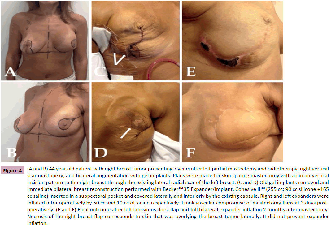 aesthetic-reconstructive-surgery-left-partial-mastectomy