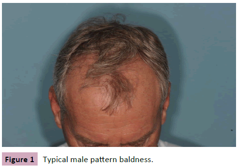 aesthetic-reconstructive-surgery-male-pattern-baldness