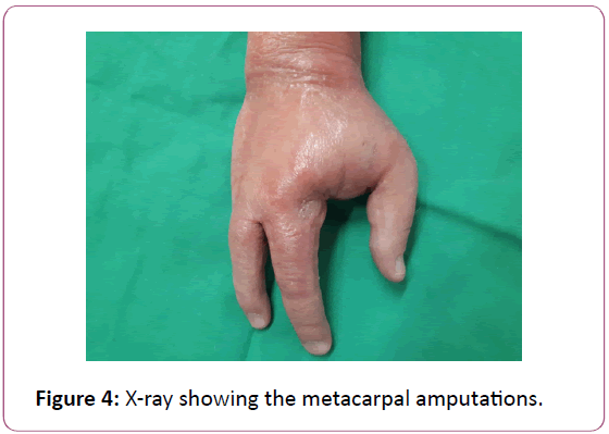 aesthetic-reconstructive-surgery-metacarpal-amputations