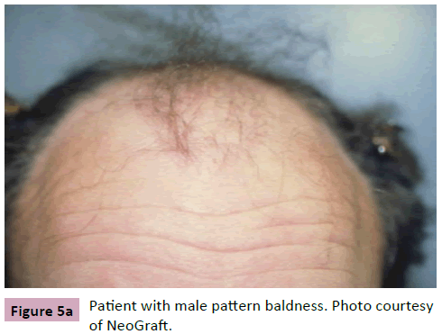 aesthetic-reconstructive-surgery-pattern-baldness-Photo