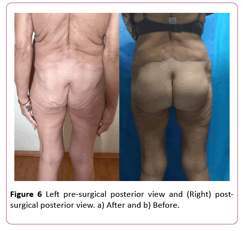 aesthetic-reconstructive-surgery-postsurgical-posterior
