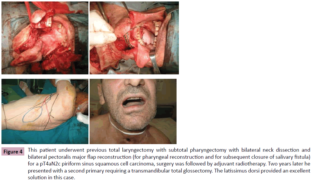 aesthetic-reconstructive-surgery-previous-total-laryngectomy