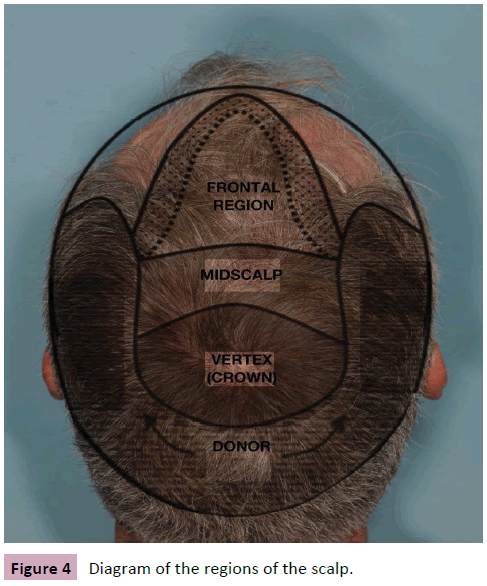 aesthetic-reconstructive-surgery-regions-scalp