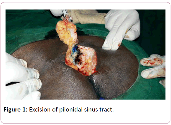 aesthetic-reconstructive-surgery-sinus-tract