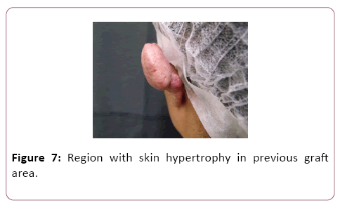 aesthetic-reconstructive-surgery-skin-hypertrophy