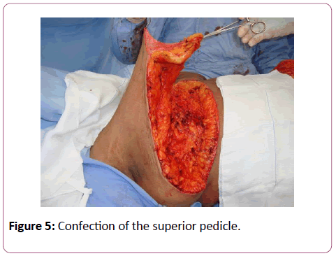 aesthetic-reconstructive-surgery-superior-pedicle