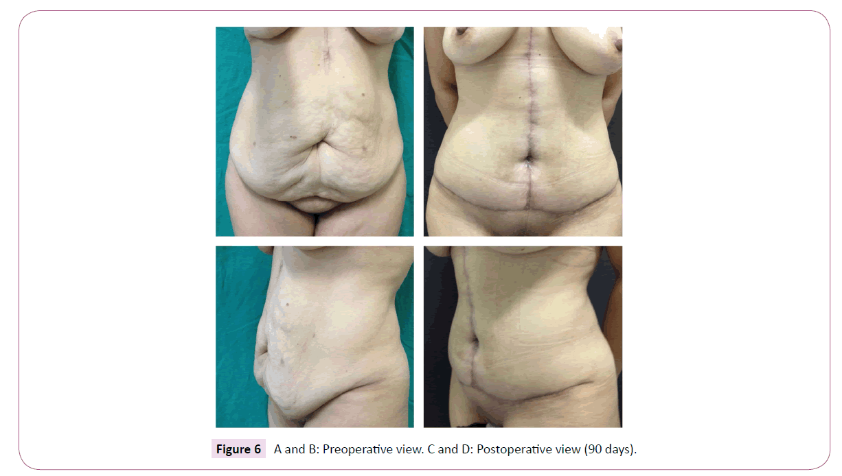 A Novel Skin Marking Technique for Excess Skin Resection by Fleur-de-lis  Abdominoplasty
